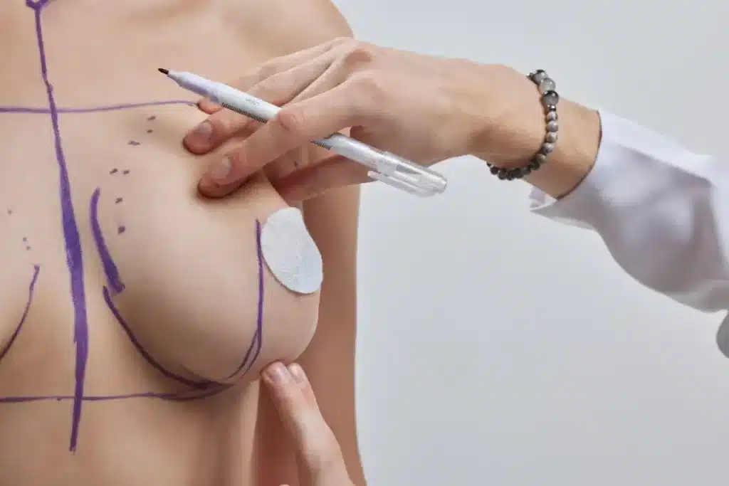 Mamoplastia de reducción