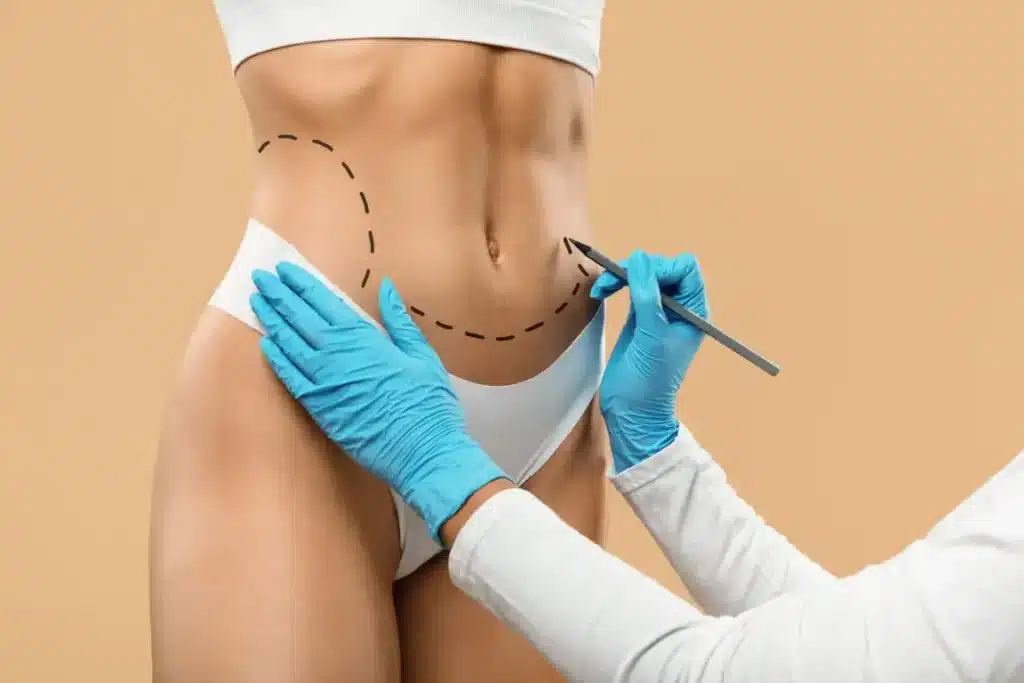Marcación abdominal