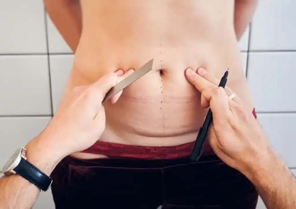 Cirugía post bariátrica