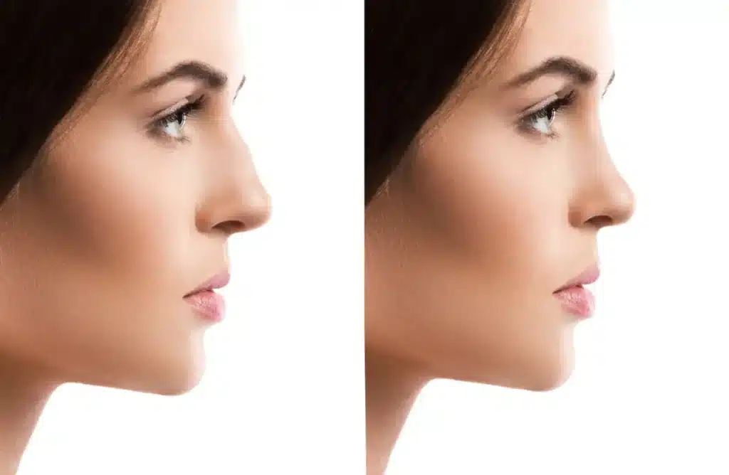 Rinoplastia